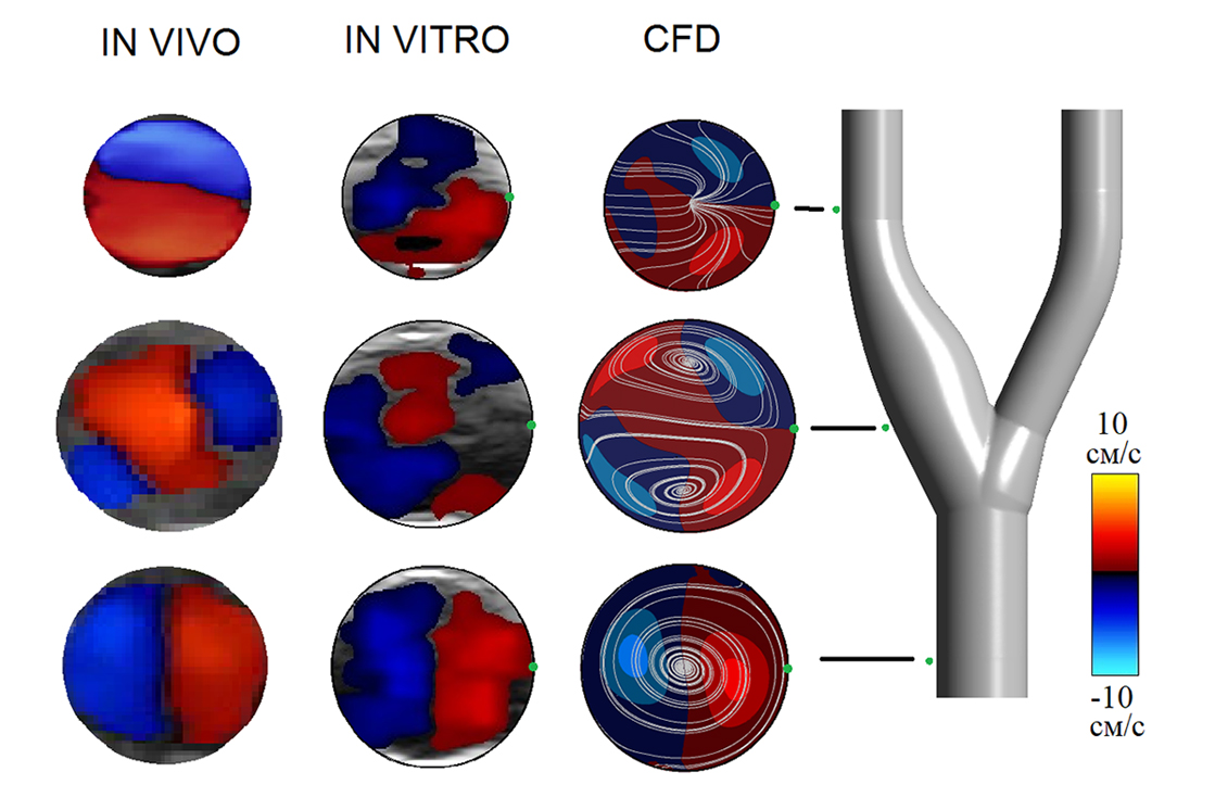 Структура вторичного течения в разных сечениях бифуркации сонной артерии